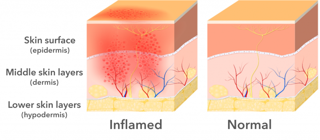Examples of inflamed and normal skin